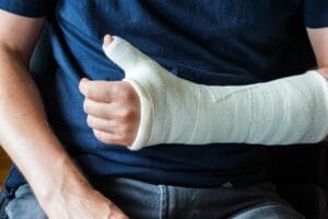 A man with a plaster cast on his broken hand, including a broken thumb and wrist.